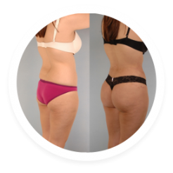 brazillian.butt.lift.image brazillian.butt.lift.image